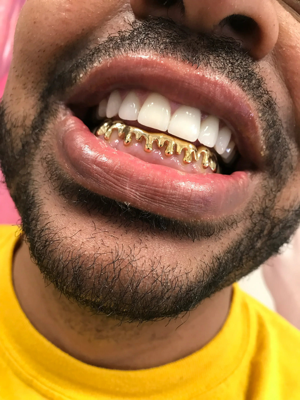 Gold Front Bar: 10k 8 Piece Drip Style Grillz  image 0