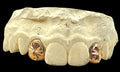 2 Gold Teeth: 10k Sunshine Cutz W/Back Bridge image 0