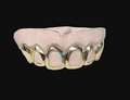 6 Teeth: 14K Gold 4 Open-Face &  2 Solid Deep Perm-cut image 0
