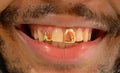 1 Gold Tooth: 14k Cut Out Single Cap Any Color Gold image 2